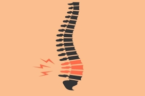 Bel Fıtığı Ameliyatında Epidural Anestezi: Güvenli ve Etkili Bir Yöntem